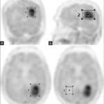 Region of interest generated over coronal (a), sagittal (b), and axial (c) FET-PET images. Background region of interest drawn over contralateral white mater (d) on axial PET image