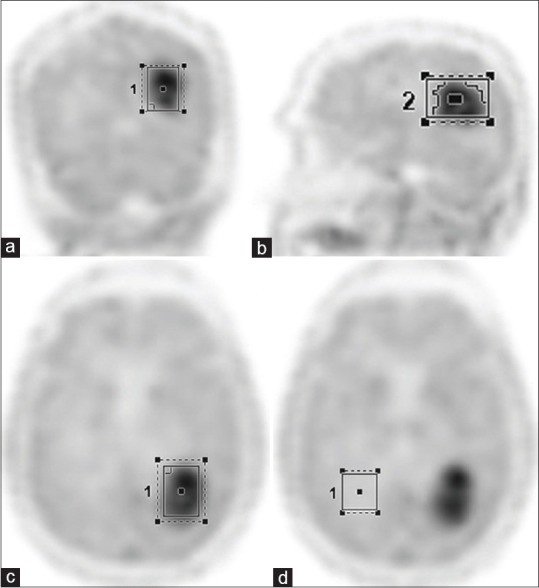 Region of interest generated over coronal (a), sagittal (b), and axial (c) FET-PET images. Background region of interest drawn over contralateral white mater (d) on axial PET image