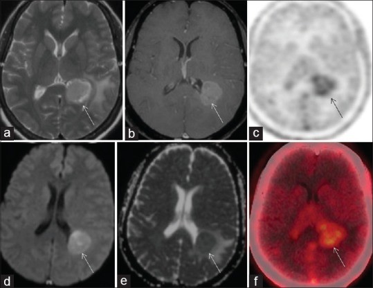 Patient 3 was a 55-year-old female, presented with headache for 1 month, axial MR sequences (arrows) show well-circumscribed mass along the occipital horn of left lateral ventricle, (a) iso-to-hypointense on T2-weighted image (b) enhancing on postcontrast T1-weighted image, with (d) restricted diffusion and (e) low apparent diffusion coefficient, hyperperfusion on MR perfusion sequence; MR spectroscopy was noncontributory. Although features were favoring PCNSL, age and rapid clinical deterioration raised the suspicion of glial tumor. Axial FET-PET (c and f) fused PET/CT images (arrows) showed increased tracer uptake in the mass, with a tumor-to-contralateral white mater ratio of 2.6 and 2.2 at 5 and 20 min. Biopsy was suggestive of the WHO Grade IV glioma – glioblastoma