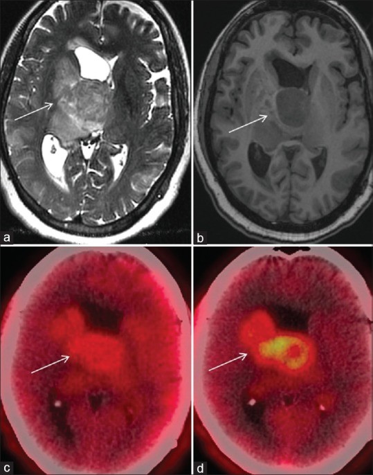 An 86-year-old male (patient 8), known case of chronic kidney disease, presenting with headache and limb weakness, underwent a MRI at a regional center; axial images (a) showed an ill-defined T1 hypointense, T2 iso-to-hypointense corpus callosal lesion infiltrating the ventricles and right thalamus, no contrast could be administered, there was facilitated diffusion on diffusion-weighted imaging and ADC map; hyperperfusion on MR perfusion images differentials of PCNSL and high-grade glioma were given. FET-PET showed tumor-to-contralateral white mater (T/Wm) ratio of 2.6 on both 5 (c) and 20 (d) minute images. 5-min image is an index of vascularity, however, since maximum uptake occurs till 20 min, increased 20-min uptake in the hyperperfused lesions seen at 5 min is suggestive of high-grade glioma. Histopathology revealed Grade IV gliomas