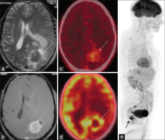 Patient 7 is a 54-year-old male, presented with progressive bilateral diminution of vision and right hemiparesis for 2 months, MRI showed (a) T2-hypointense lesion in the left occipital region, with perilesional edema. (b) Axial postcontrast T1-weighted image showed homogeneous enhancement. MR spectroscopy and perfusion were noncontributory. Differentials were high-grade glioma, PCNSL with rare possibility of metastases. FET-PET was done (c), which showed low-grade uptake in the lesion with a tumor-to-contralateral white mater (T/Wm) ratio of 1.6 at 5 and 20 min. Patient was not willing for biopsy; hence, whole-body FDG PET was done which showed rim of increased uptake in the brain lesion ([d] equal to gray matter), and primary site in the anal canal, seen on maximum intensity projection (MIP) image ([e] – arrow), biopsy showed anal melanoma, thus brain lesion was most likely metastatic. FET-PET (T/Wm) ratio was useful in ruling out high-grade glioma