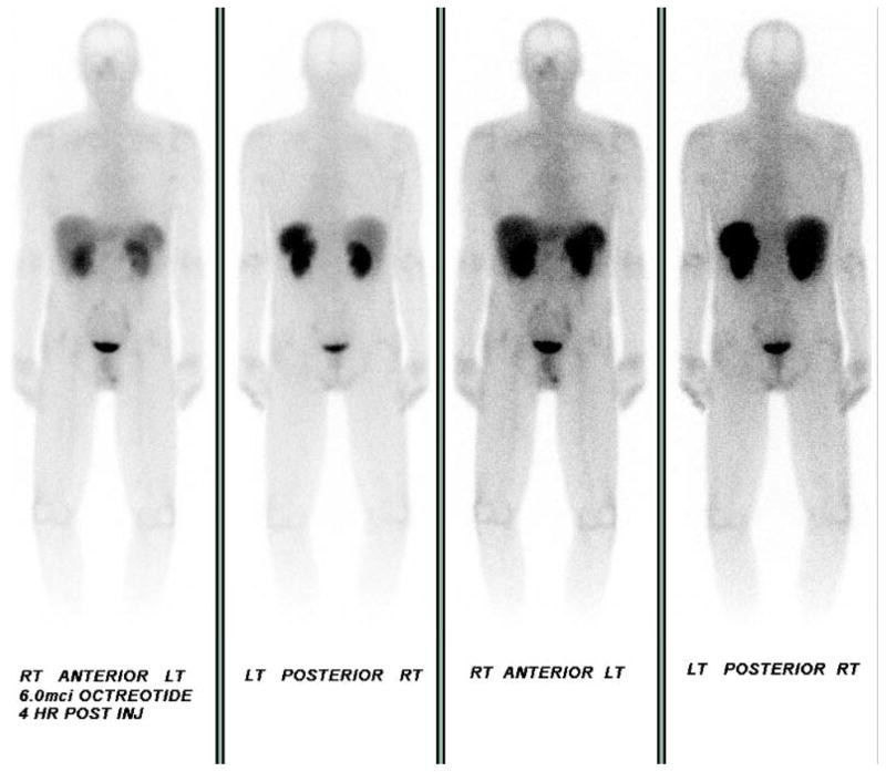 68Ga-DOTATATE PET/CT scan showing liver and small bowel involvement